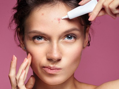 A benzoil-peroxid a legjobb helyi pattanáskezelő, ám sok mellékhatása is van