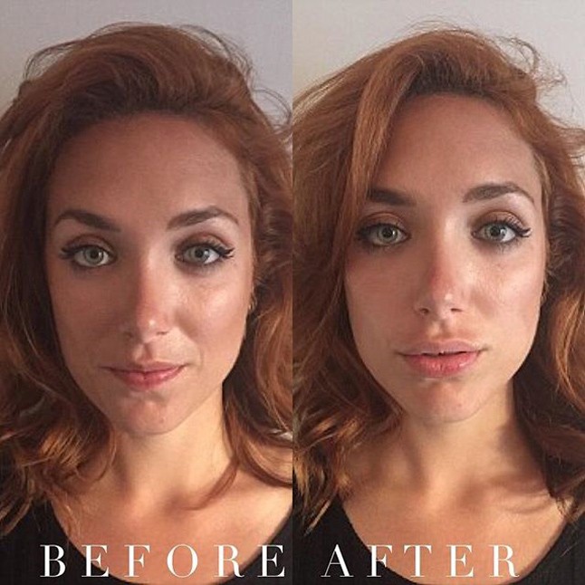 Az új plasztikai őrület a Hamupipőke ajak