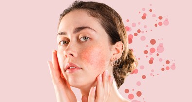 Lehet, hogy a te arcod is a  rosacea miatt piros? A szakértő minden kérdésedre választ ad
