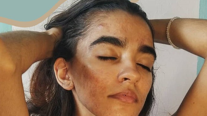 3 típusú hormonális változás, ami rossz hatással van a bőrödre