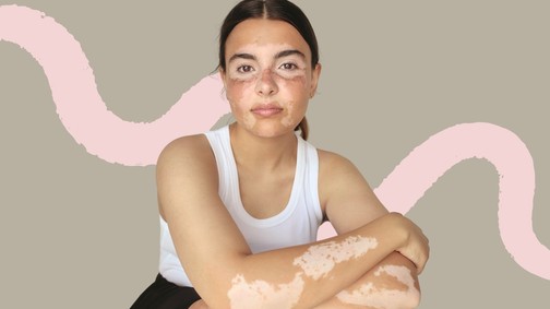 Ezt üzeni a tested, amikor pigmenthiányt, azaz vitiligót tapasztalsz