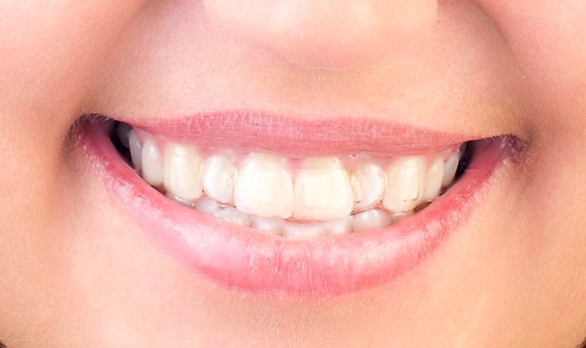 A legújabb trend: Láthatatlan fogszabályzó!