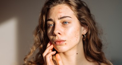 Végre itt a magyarázat: ez a bőrprobléma okozza a legtöbb mentális problémát