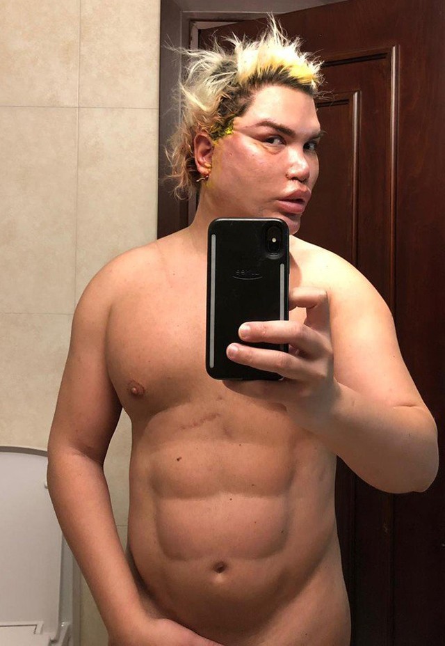 Beteges: ilyen borzalmasan néz ki 69 plasztikai műtét után az élő Ken baba arca