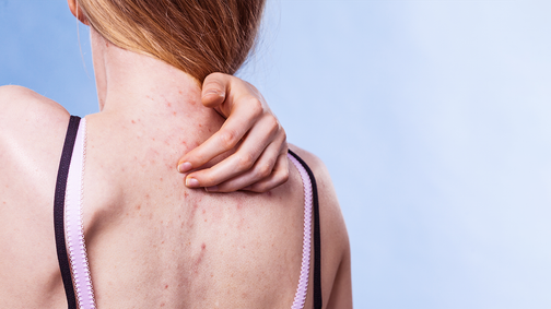 Így szabadulj meg az idegesítő pattanásoktól a hátadon