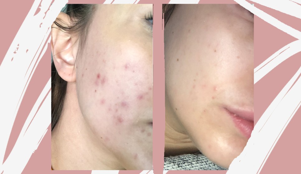 A bőröm története: így szabadultam meg a pattanásoktól és a hegektől