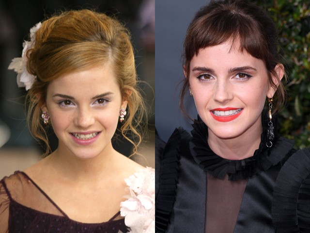 Előtte-utána: sztárok, akik megcsináltatták a fogukat