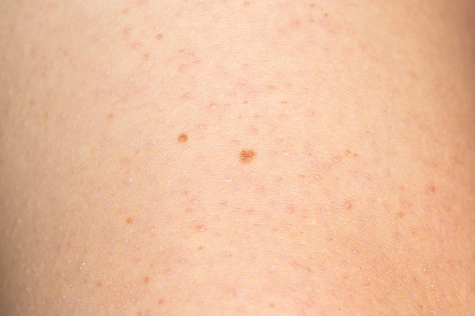 Keratosis pilaris, azaz a csirkebőr