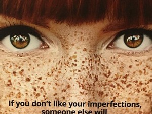 Szeplős vagy? Talán lesz, aki szeretni fog így is.