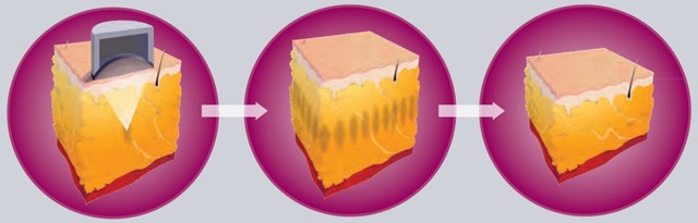 Végleges zsíreltávolítás vágás nélkül