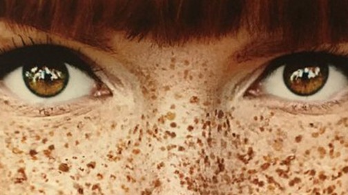 Szeplős vagy? Talán lesz, aki szeretni fog így is.