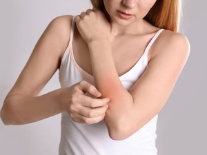 Atópiás a bőröd? Így ápold!