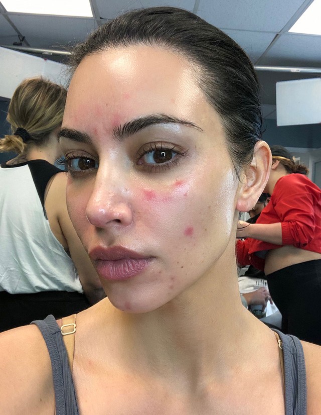 Kim Kardashian pikkelysömör tünetei