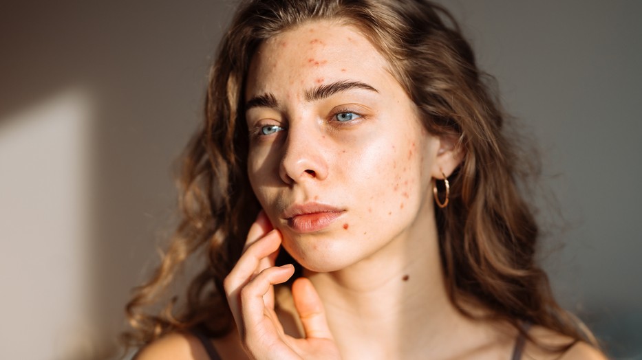 A bőröd állapota a mentális egészségedre is kihathat