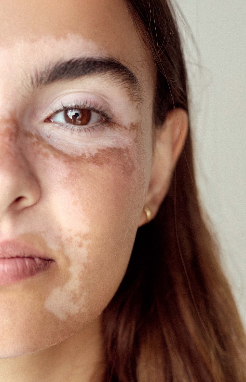 Szélsőséges esetekben akár egy nagyobb veszteség, vagy trauma is előidézheti a pigmenthiányt a bőrben