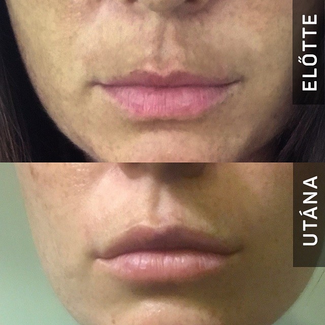 Faarc helyett felszabadult mosoly: Így működik a botox és a hiarulonsav!