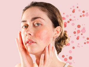 Lehet, hogy a te arcod is a  rosacea miatt piros? A szakértő minden kérdésedre választ ad