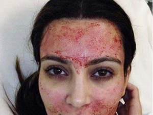 Borzalmas betegségeket okozhat a népszerű Vámpír-terápia