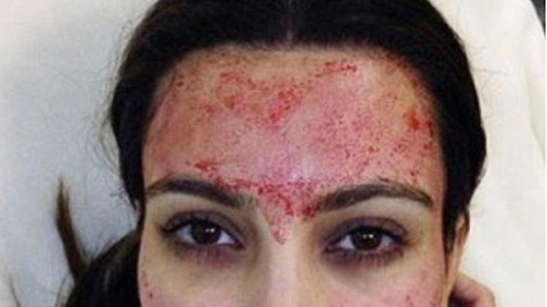 Borzalmas betegségeket okozhat a népszerű Vámpír-terápia