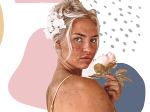 Meglepő, de ezek a dolgok pattanást okozhatnak!