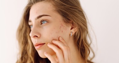 5 pattanás típus, amit soha nem szabad kinyomni