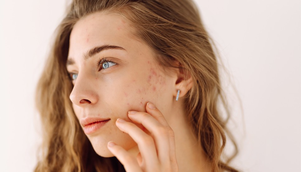 Az alkohol súlyosbíthatja a pattanásos bőr állapotát