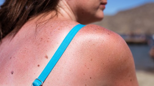 Leégtél hétvégén és most hámlik a bőröd? 5 tipp, hogyan hozd rendbe