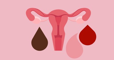 Ezt próbálja jelezni neked a menstruációs vérzésed színe az egészségedről