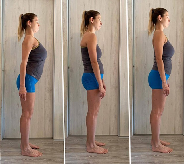 Megelőzhető a szétnyílt hasizom kialakulása a terhesség alatt?