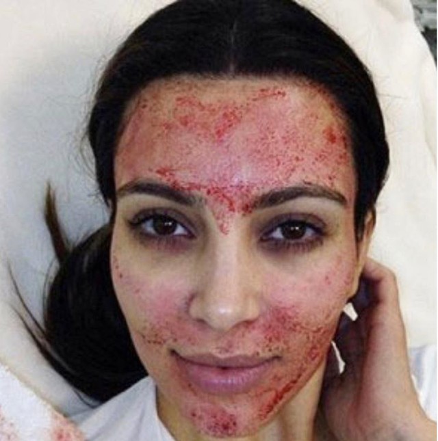 Borzalmas betegségeket okozhat a népszerű Vámpír-terápia