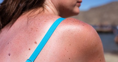 Leégtél hétvégén és most hámlik a bőröd? 5 tipp, hogyan hozd rendbe