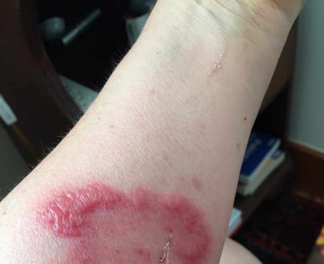 Vigyázat! Ezek az iPhone tokok égési sérüléseket okoztak!