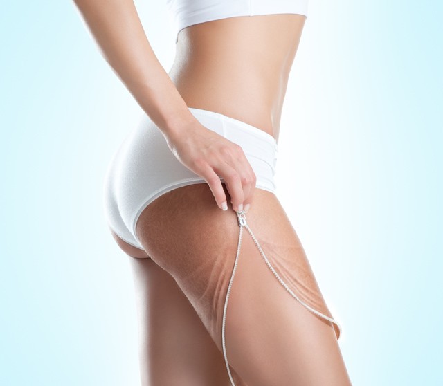 4 tipp, hogy TÉNYLEG leszámolj a narancsbőrrel