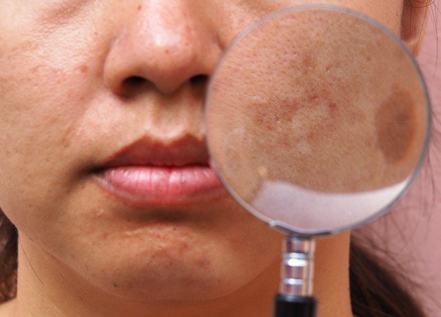 Ha nyár, akkor napfoltok? Készülj az őszi hámlasztásra!