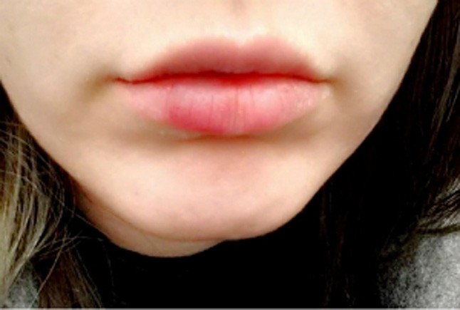 Ajakfeltöltés Jenner módra