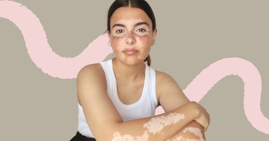 Ezt üzeni a tested, amikor pigmenthiányt, azaz vitiligót tapasztalsz