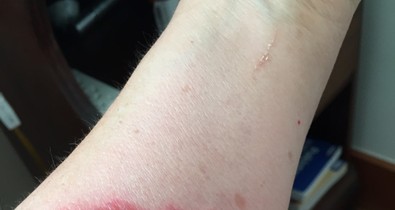 Vigyázat! Ezek az iPhone tokok égési sérüléseket okoztak!