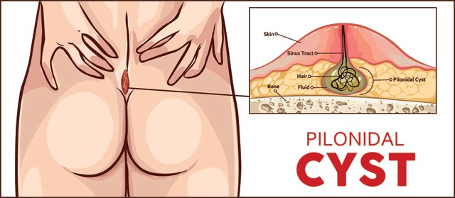 Sajnos ez a ciszta a sok üléstől is kialakulhat