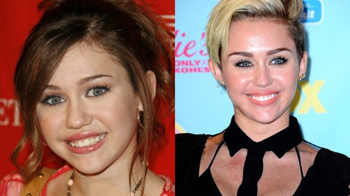 Előtte-utána: sztárok, akik megcsináltatták a fogukat