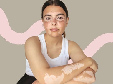 Ezt üzeni a tested, amikor pigmenthiányt, azaz vitiligót tapasztalsz