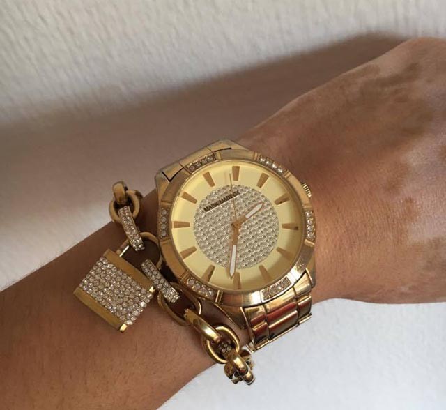 Széles Adrienn vitiligo