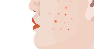 Pattanások felnőttkorban? Ezek az okok lehetnek a háttérben!