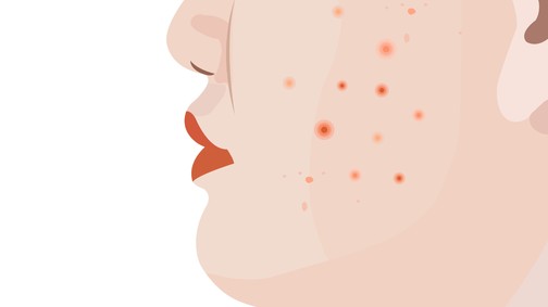 Pattanások felnőttkorban? Ezek az okok lehetnek a háttérben!