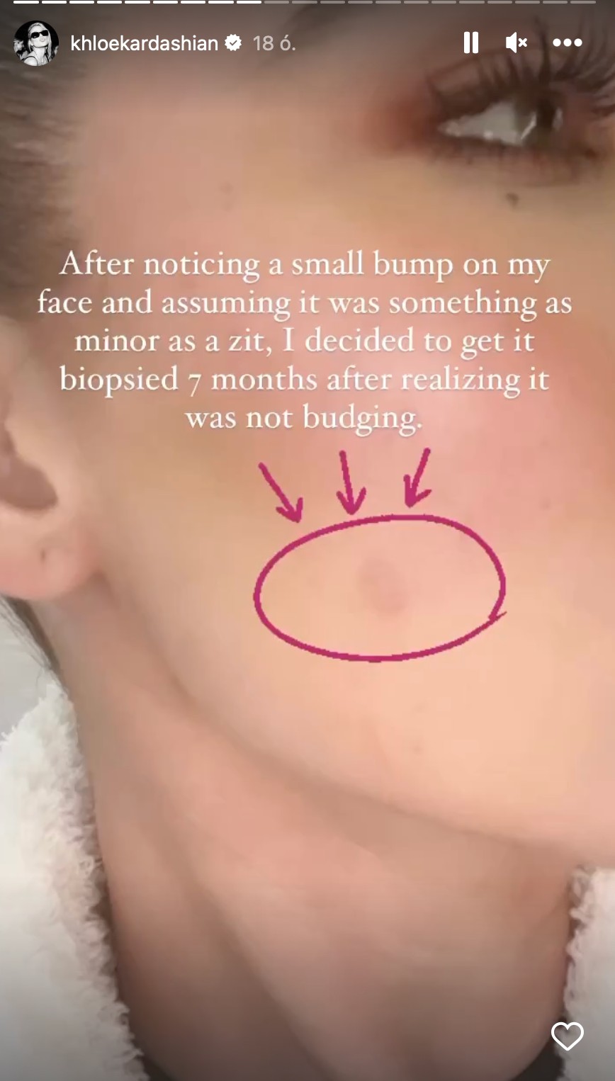 Khloé Kardashian apró elváltozást fedezett fel a bőrén néhány hónapja, amiről később kiderült, hogy daganat