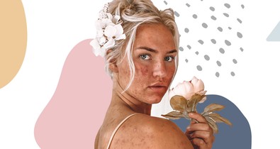 Meglepő, de ezek a dolgok pattanást okozhatnak!