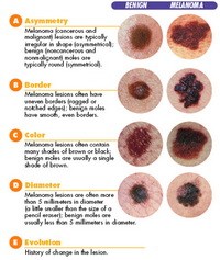 melanoma, szűrés, anyajegy