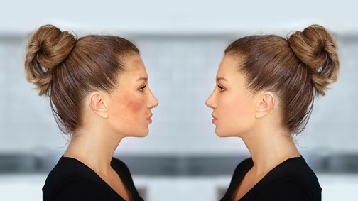 Barna foltok jelentek meg a bőrödön? Hagyd a tejfölt, van rá profi otthoni megoldás!