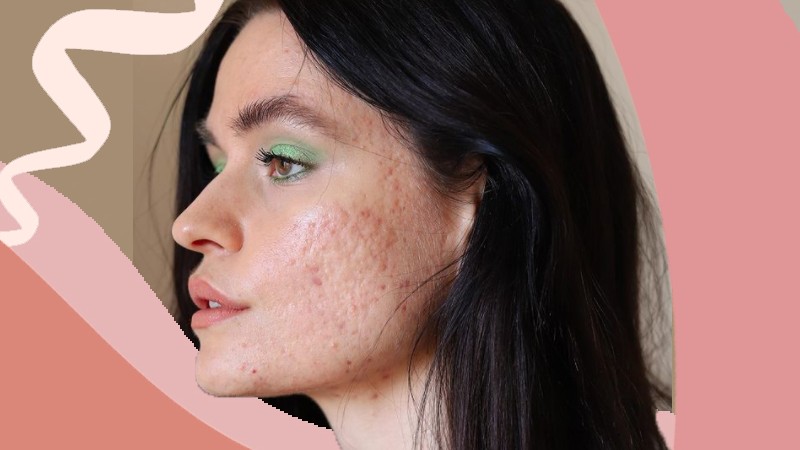 9 példamutató influenszer, aki elfogadja bőrét úgy, ahogy van