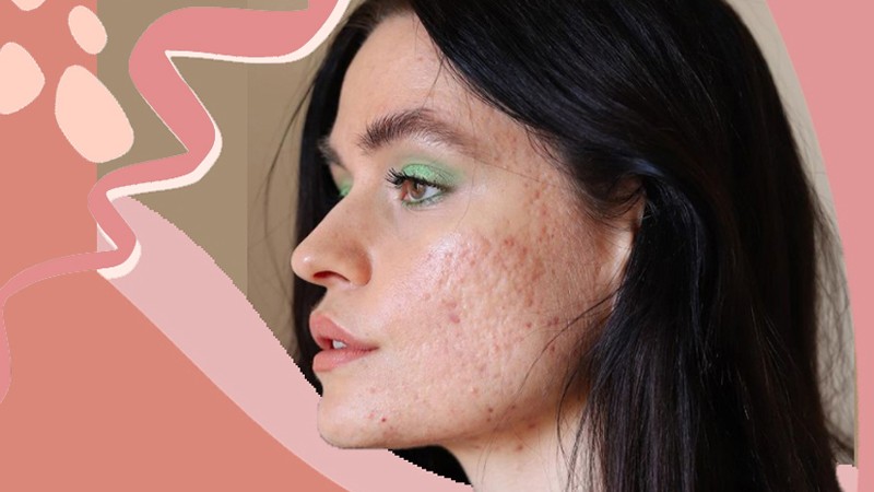 5 dolog, amit bárcsak tudtam volna a pattanásokról 18 évesen