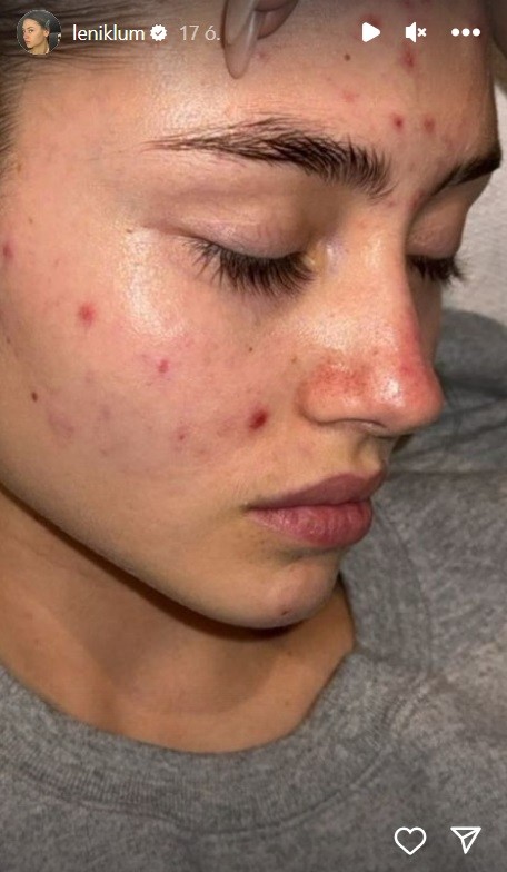 Leni Klum smink nélkül mutatta meg pattanásos arcbőrét